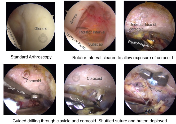 AC Joint Reconstruction and Shoulder Separation, Shoulder Surgeon